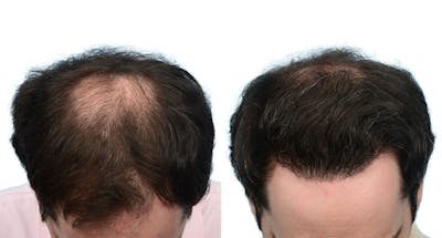 FUE Hair Transplant Before & After Gallery - Patient 393683 - Image 1
