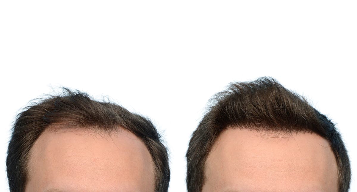 FUE Hair Transplant Before & After Gallery - Patient 531478 - Image 2
