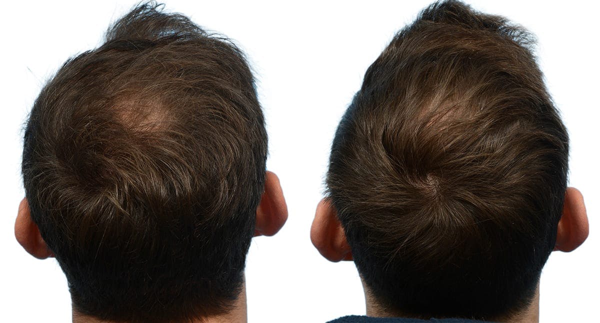 FUE Hair Transplant Before & After Gallery - Patient 531478 - Image 1