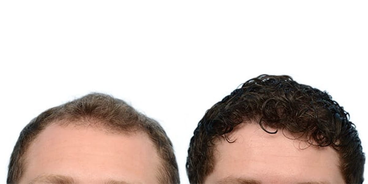 FUE Hair Transplant Before & After Gallery - Patient 955612 - Image 2