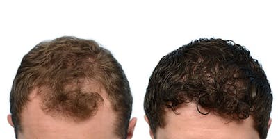 FUE Hair Transplant Before & After Gallery - Patient 955612 - Image 1