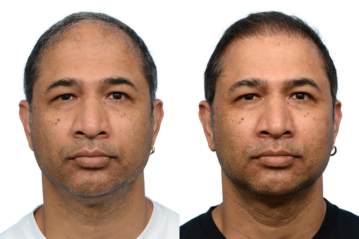 FUE Hair Transplant Before & After Gallery - Patient 400448 - Image 2