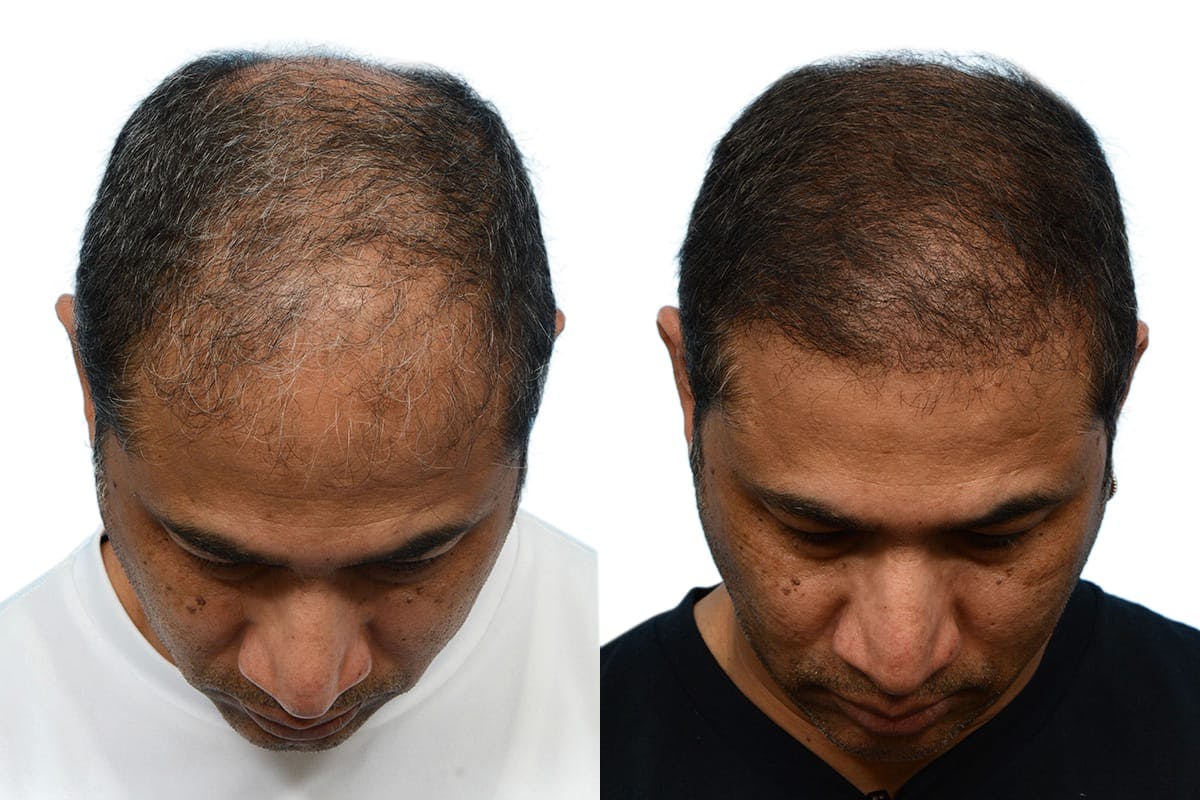 Platelet-Rich-Plasma Before & After Gallery - Patient 265901 - Image 1