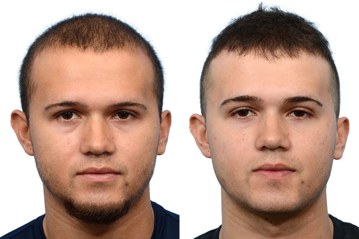 FUE Hair Transplant Before & After Gallery - Patient 107424 - Image 2