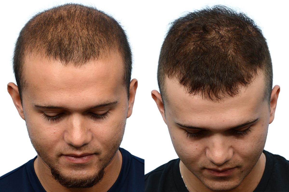 Hair Restoration Before & After Gallery - Patient 587938 - Image 3