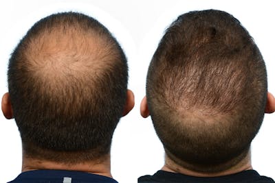 Hair Restoration Before & After Gallery - Patient 587938 - Image 1