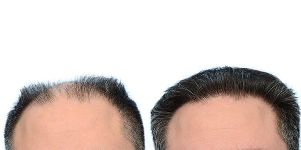 Hair Restoration Before & After Gallery - Patient 921383 - Image 2