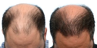 FUE Hair Transplant Before & After Gallery - Patient 128191 - Image 1