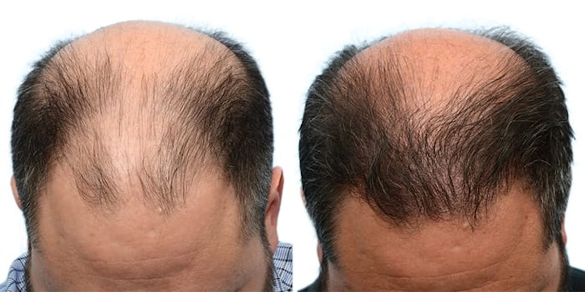 FUE Hair Transplant Before & After Gallery - Patient 128191 - Image 1