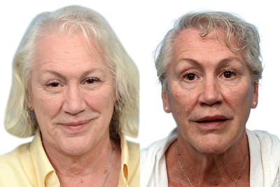 Female Hair Restoration Before & After Gallery - Patient 257937 - Image 1