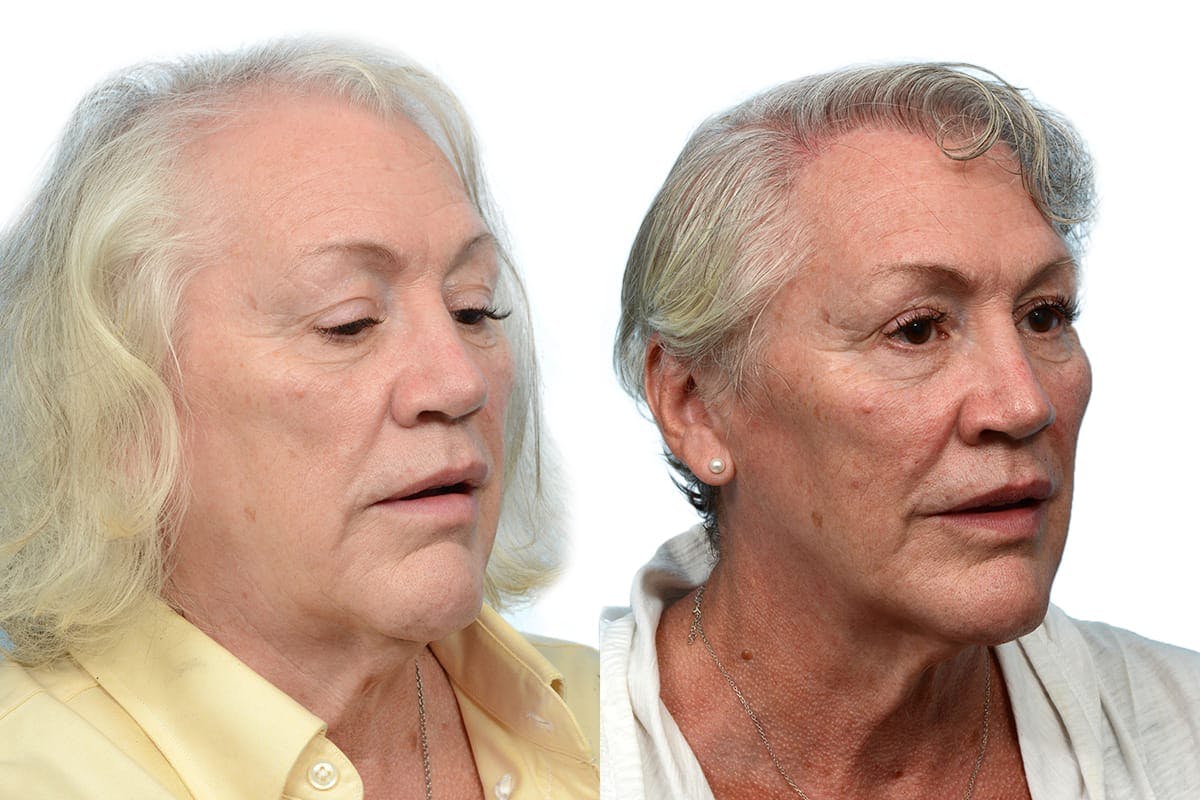 Platelet-Rich-Plasma Before & After Gallery - Patient 127200 - Image 2