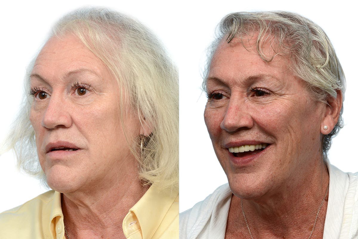 Hair Restoration Before & After Gallery - Patient 375050 - Image 3
