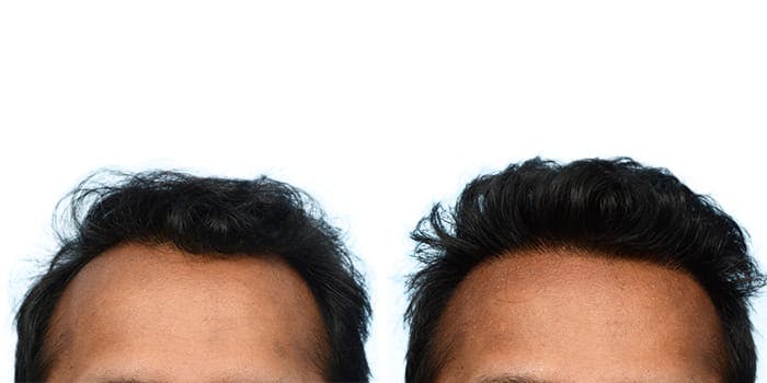 Hair Restoration  Before & After Gallery - Patient 195939 - Image 1
