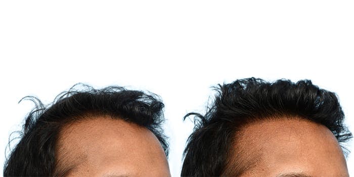 Hair Restoration  Before & After Gallery - Patient 195939 - Image 2