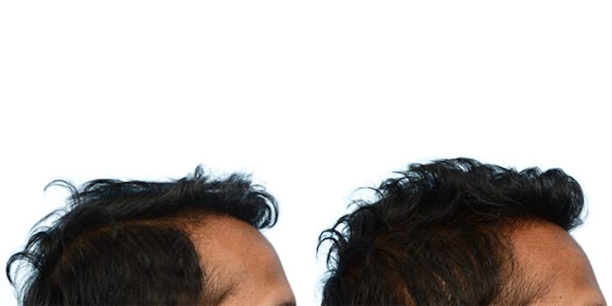 FUE Hair Transplant Before & After Gallery - Patient 582463 - Image 3