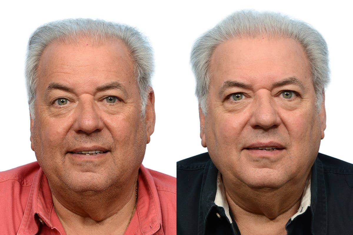 FUE Hair Transplant Before & After Gallery - Patient 283834 - Image 2