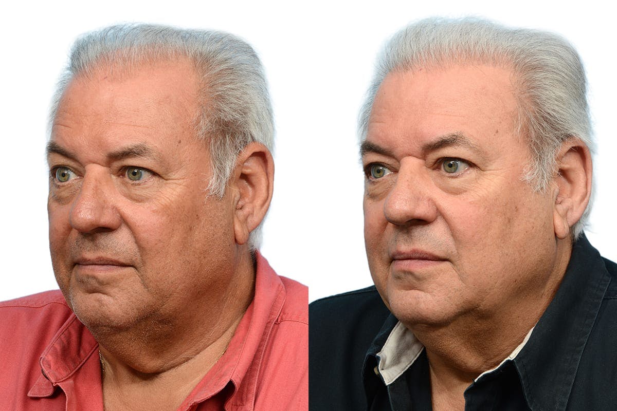 Hair Restoration Before & After Gallery - Patient 116243 - Image 3