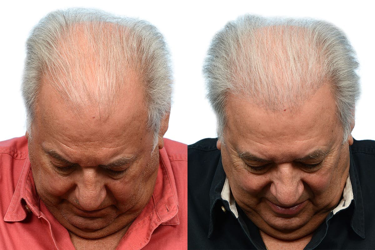 Platelet-Rich-Plasma Before & After Gallery - Patient 605619 - Image 1