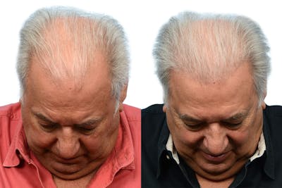 Hair Restoration Before & After Gallery - Patient 116243 - Image 1