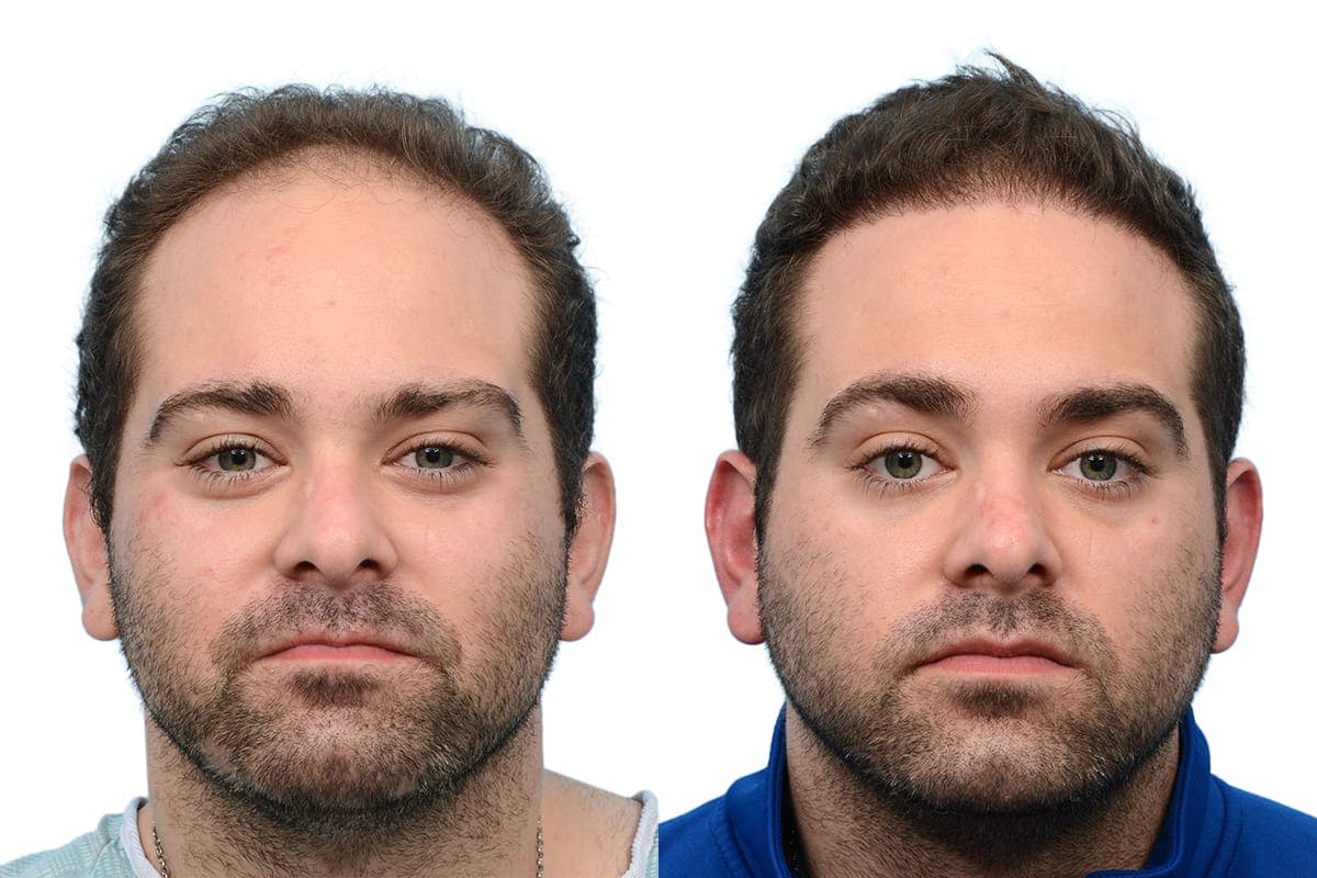 Hair Restoration Before & After Gallery - Patient 376745 - Image 2