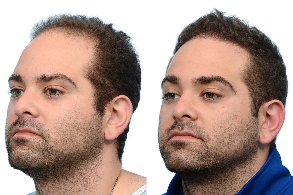 Hair Restoration Before & After Gallery - Patient 376745 - Image 3