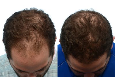 FUE Hair Transplant Before & After Gallery - Patient 143636 - Image 1