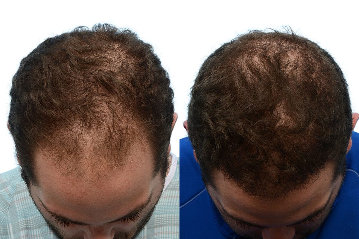 FUE Hair Transplant Before & After Gallery - Patient 143636 - Image 1