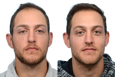 FUE Hair Transplant Before & After Gallery - Patient 117132 - Image 1
