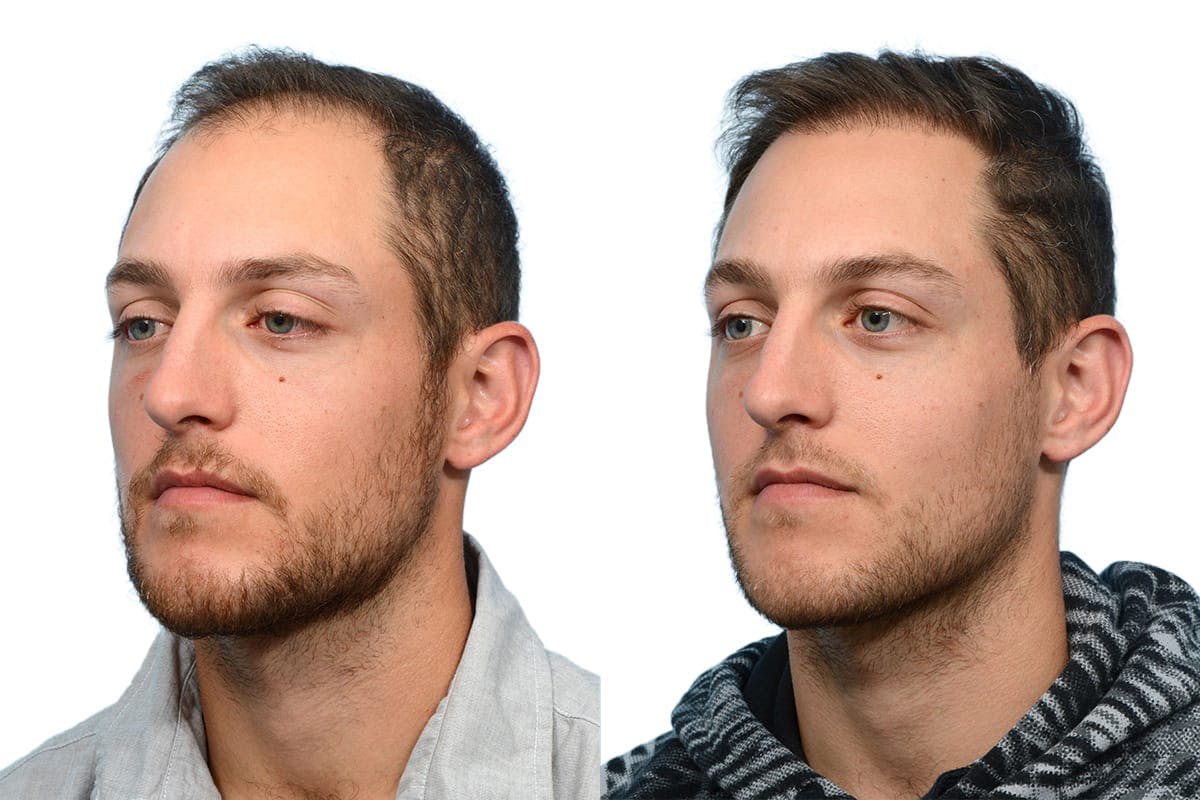 FUE Hair Transplant Before & After Gallery - Patient 117132 - Image 2