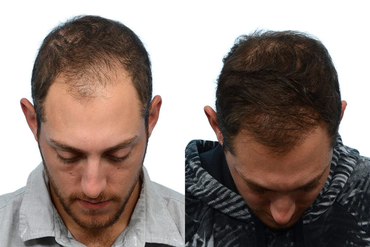 FUE Hair Transplant Before & After Gallery - Patient 117132 - Image 3