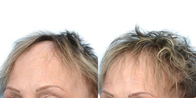 Hair Restoration Before & After Gallery - Patient 239618 - Image 1