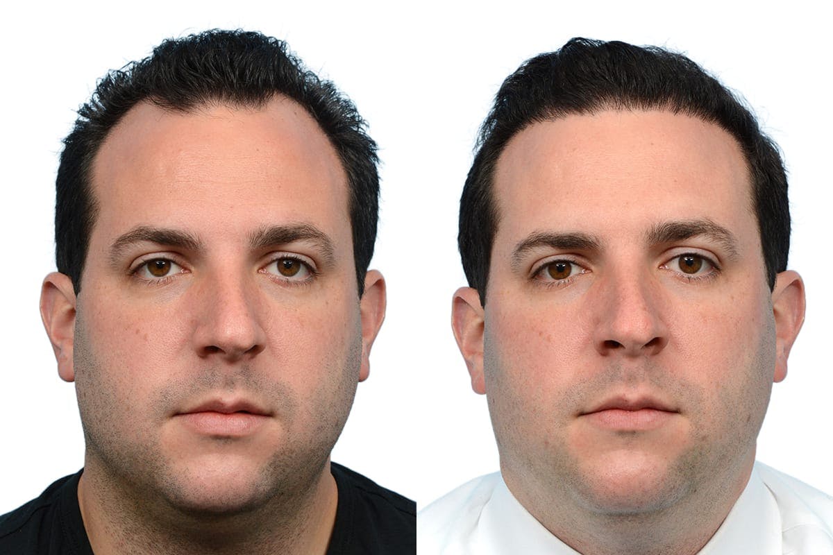 Hair Restoration Before & After Gallery - Patient 298804 - Image 2