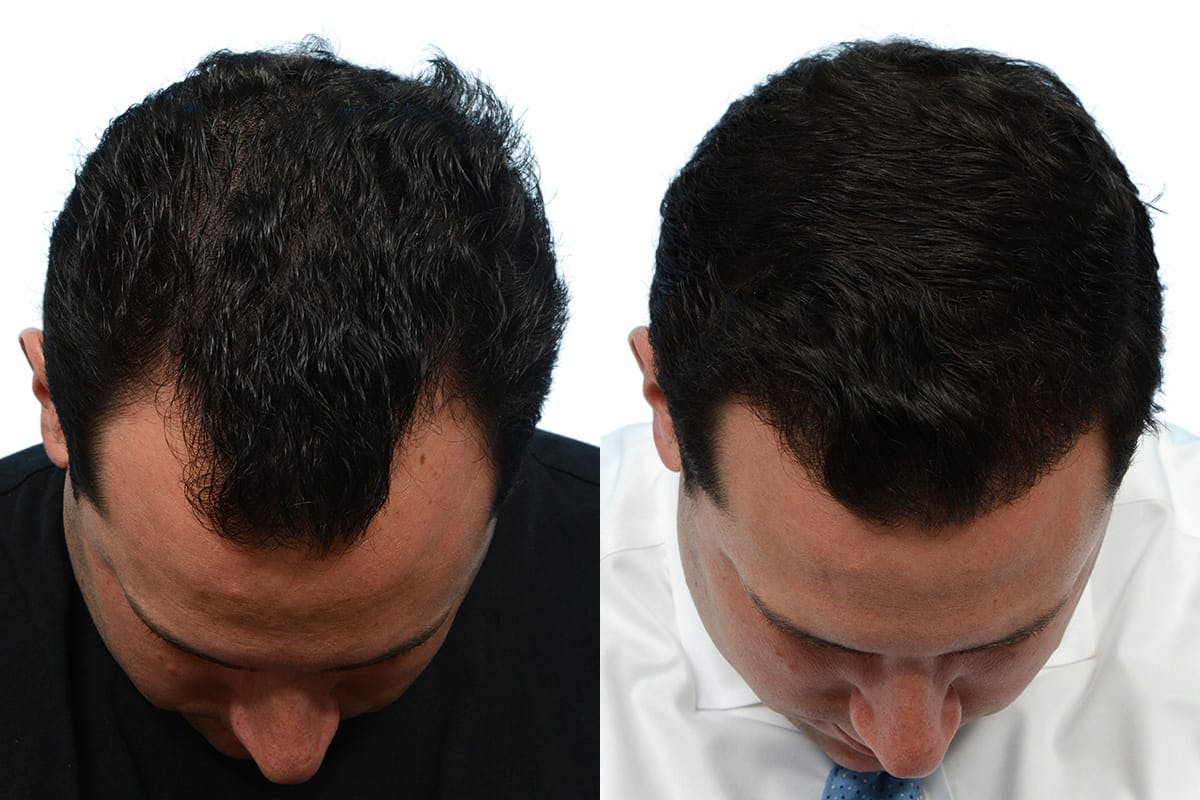 Hair Restoration Before & After Gallery - Patient 298804 - Image 1