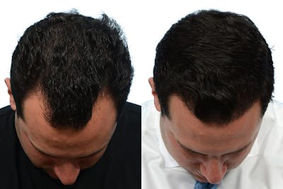 Hair Restoration Before & After Gallery - Patient 298804 - Image 1