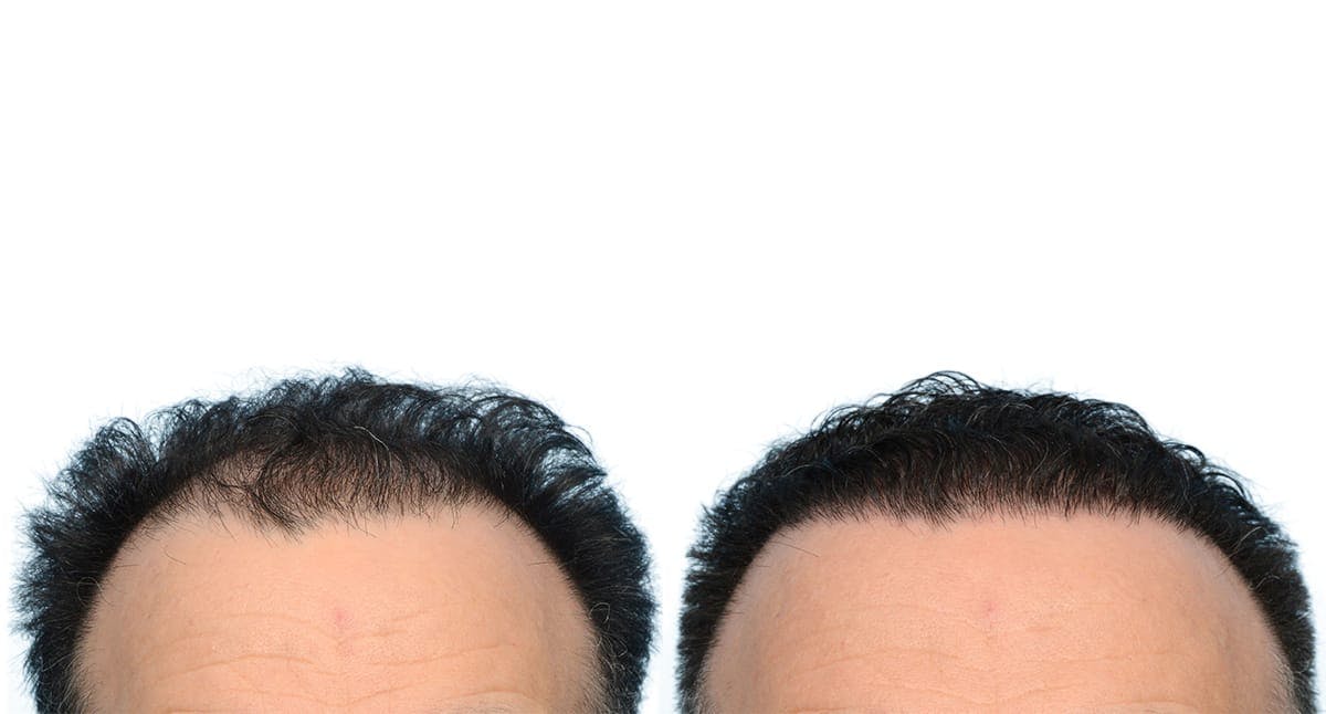 FUE Hair Transplant Before & After Gallery - Patient 959816 - Image 2