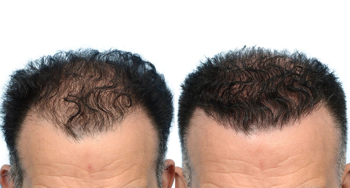 Hair Restoration Before & After Gallery - Patient 694448 - Image 3