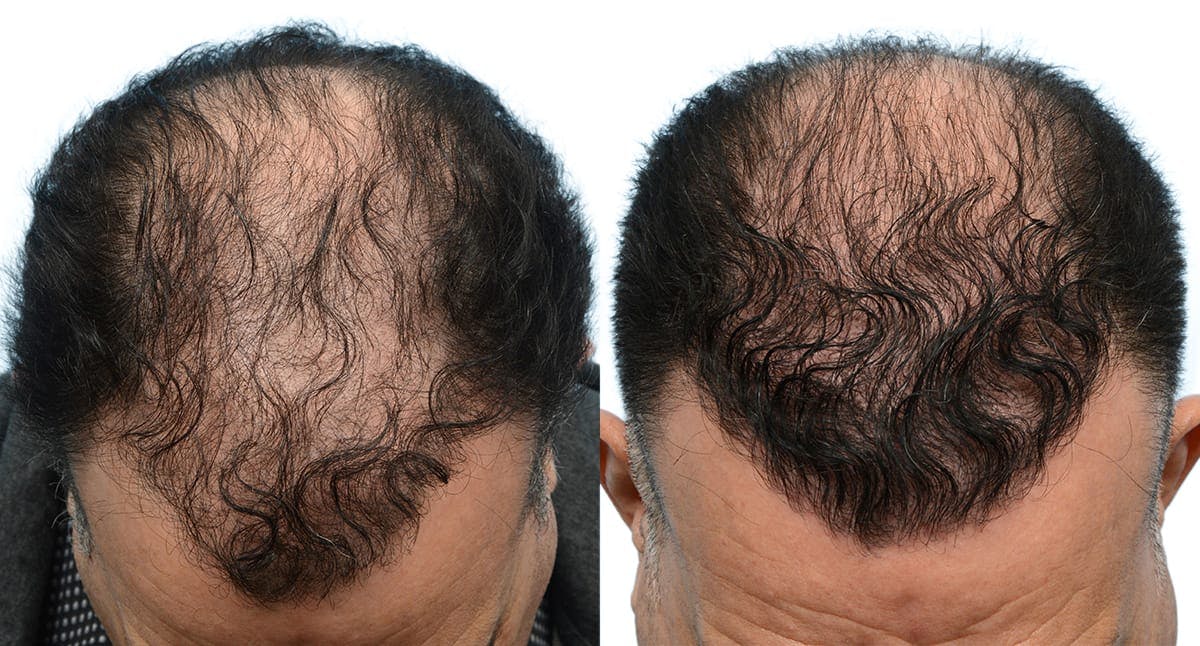 FUE Hair Transplant Before & After Gallery - Patient 959816 - Image 1