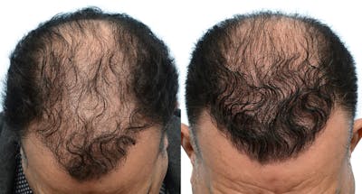 FUE Hair Transplant Before & After Gallery - Patient 959816 - Image 1