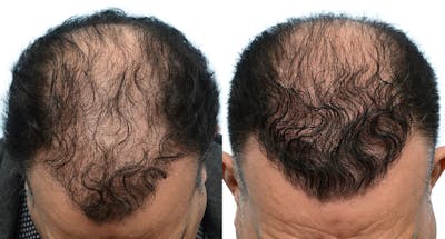 Hair Restoration Before & After Gallery - Patient 694448 - Image 1