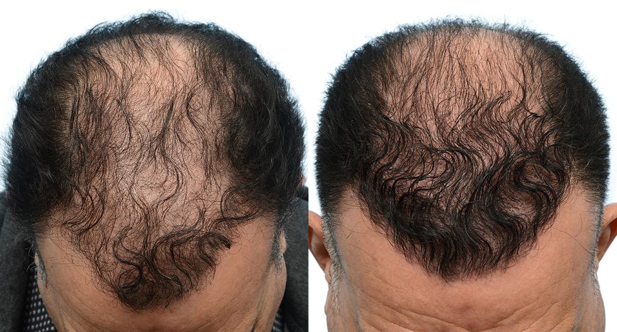 Hair Restoration Before & After Gallery - Patient 694448 - Image 1