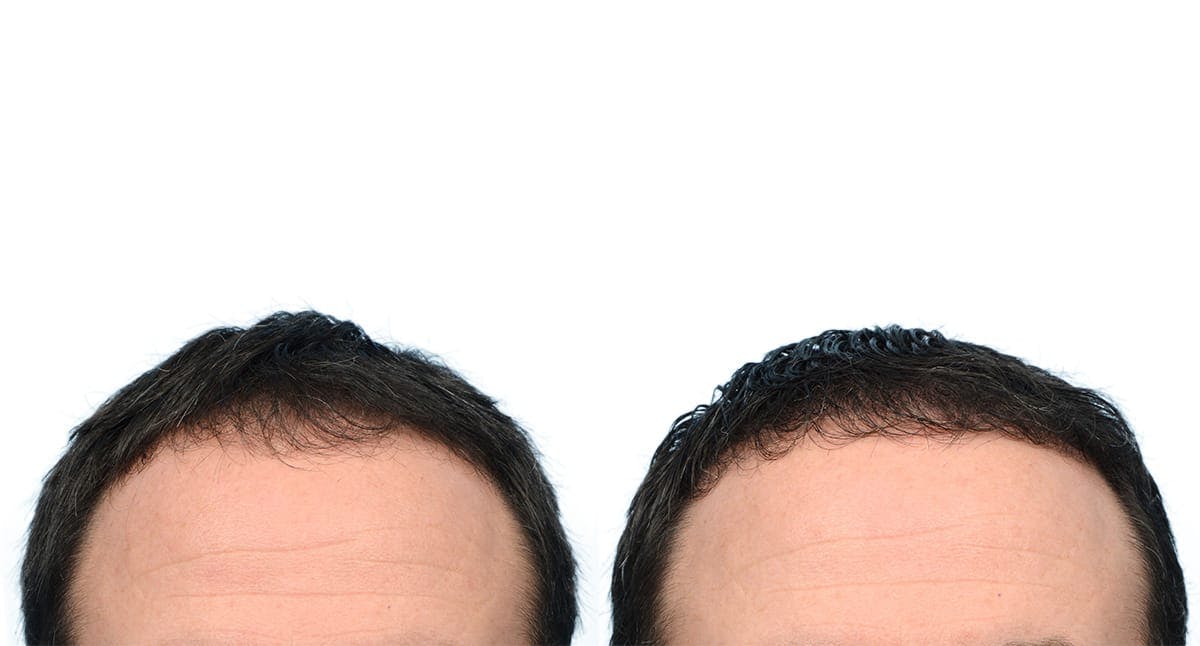 FUE Hair Transplant Before & After Gallery - Patient 736016 - Image 2