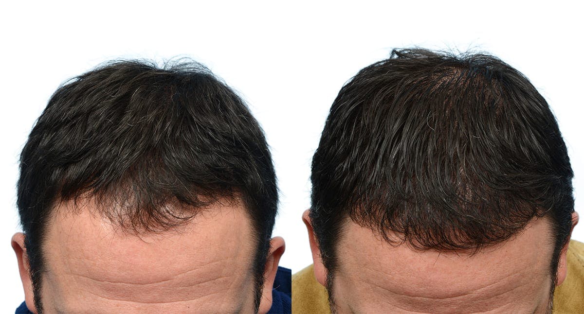 FUE Hair Transplant Before & After Gallery - Patient 736016 - Image 1