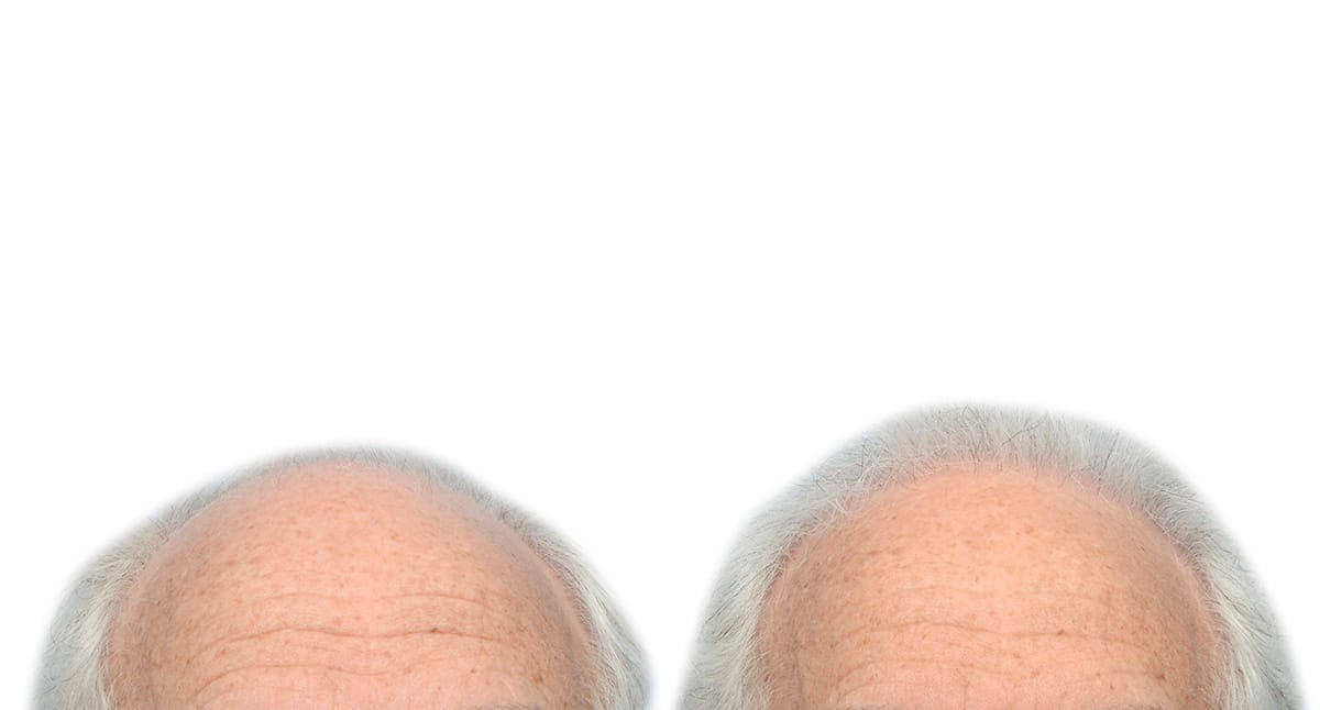 Hair Restoration Before & After Gallery - Patient 311061 - Image 2