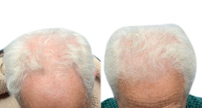 FUE Hair Transplant Before & After Gallery - Patient 156244 - Image 1