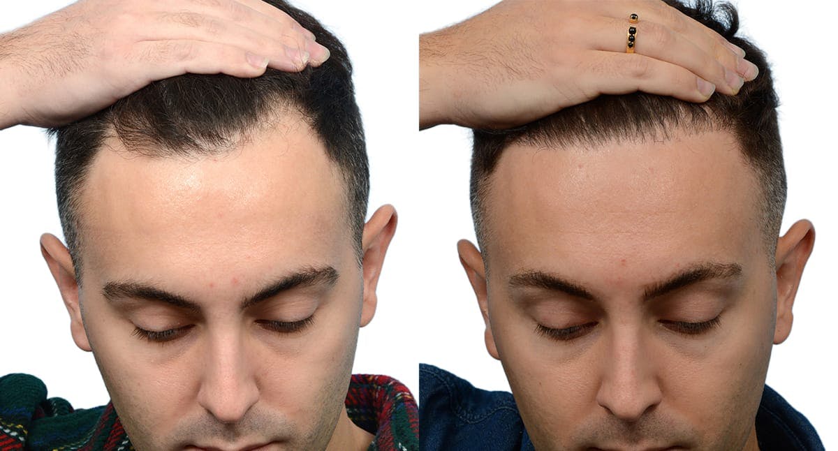 FUE Hair Transplant Before & After Gallery - Patient 820809 - Image 1