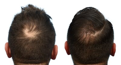 Hair Restoration Before & After Gallery - Patient 188013 - Image 1