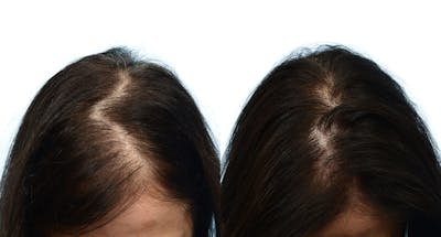 Hair Restoration Before & After Gallery - Patient 247087 - Image 1
