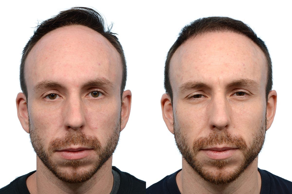 Hair Restoration Before & After Gallery - Patient 266334 - Image 2