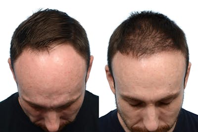 Hair Restoration Before & After Gallery - Patient 266334 - Image 1