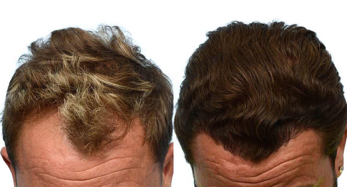 FUE Hair Transplant Before & After Gallery - Patient 525209 - Image 1